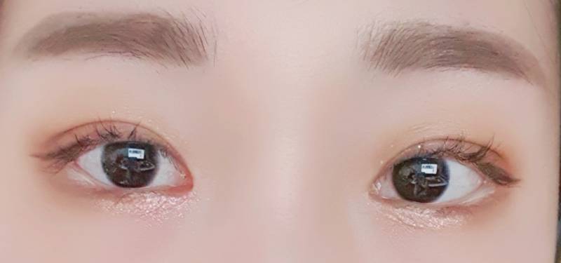 쌍수 전 후 40 (별거 없음 주의 | 인스티즈