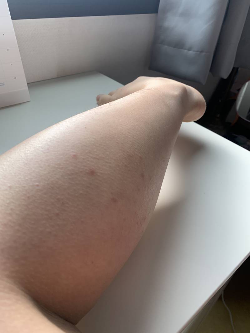 익들아 나 이거 피부과 가야할까 | 인스티즈