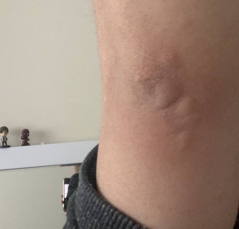 내 팔 왜이런지 아는 익 ㅠㅠ(혐오주의) 40 | 인스티즈