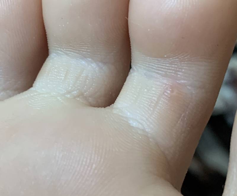 발가락에 여드름 같은 게 있어 ㅠㅠ 이거 뭐야 | 인스티즈