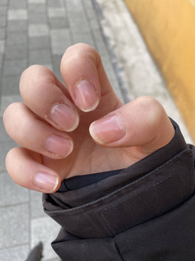 손톱 갈라지는 거 네일샵에서 기본 케어 받으면 괜찮아지나? (혐오주의) | 인스티즈