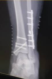 나 수술했는데 이 정도면 교통사고 급 아니니?(사진주의) | 인스티즈