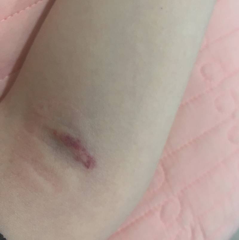 어제 피 뽑았는데 왜이래ㅠㅜㅜㅠ 멍같은 사진 있음! | 인스티즈