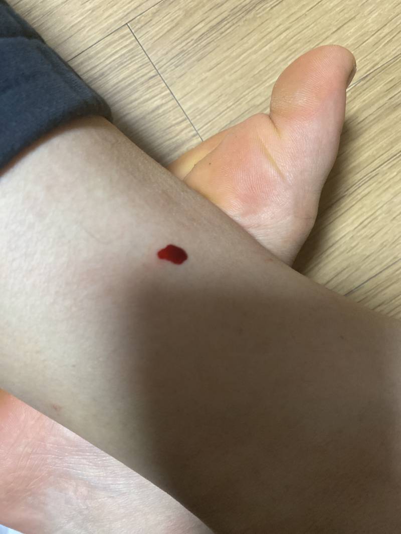 갑자기 다리에서 피가 나 ...(혐오주의) | 인스티즈