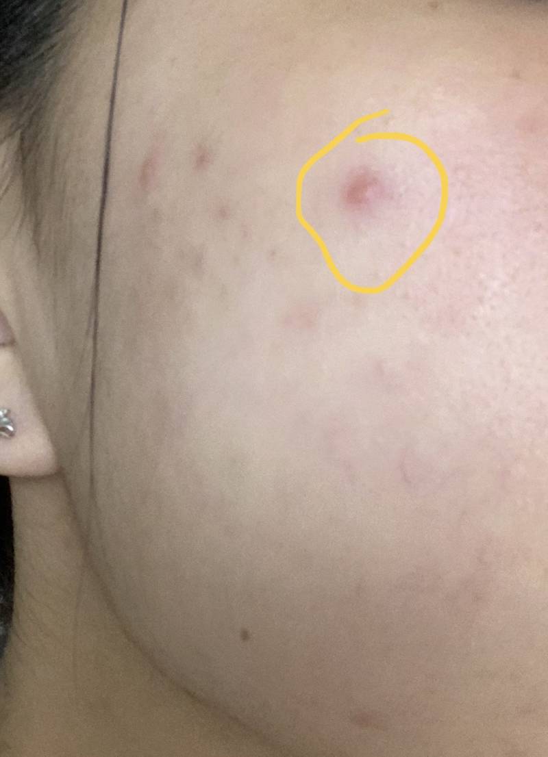 이 정도 여드름이면 짜지 말아야 할까 약 (ㅎㅇㅈㅇ) | 인스티즈