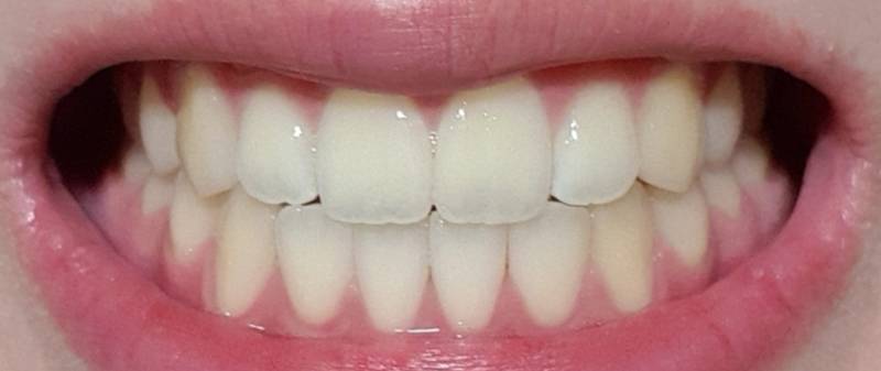 미백치약 한달 사용 후기 치아 40 | 인스티즈