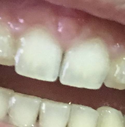 교정기 땠는데 이빨 색깔이 이상해; (이빨사진주의 | 인스티즈