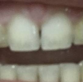 교정기 땠는데 이빨 색깔이 이상해; (이빨사진주의 | 인스티즈