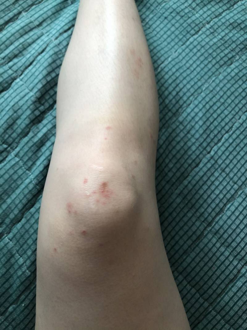 혐)모기한테 작살난 내 다리볼사람... 언제 가라앉을까 | 인스티즈