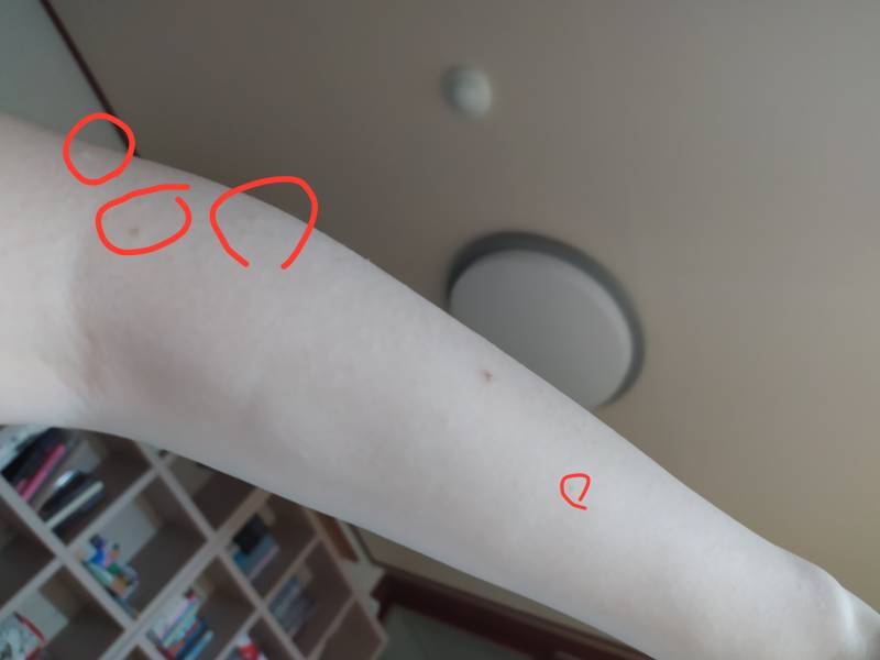 팔에 이런거 뭐야?ㅠㅠ | 인스티즈