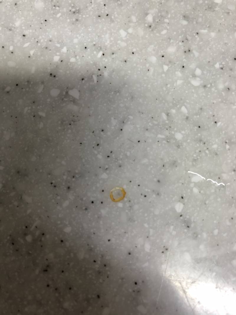 교정한 익들아ㅠㅠ 이거 고무 빠진거 맞지...?ㅜㅠ | 인스티즈