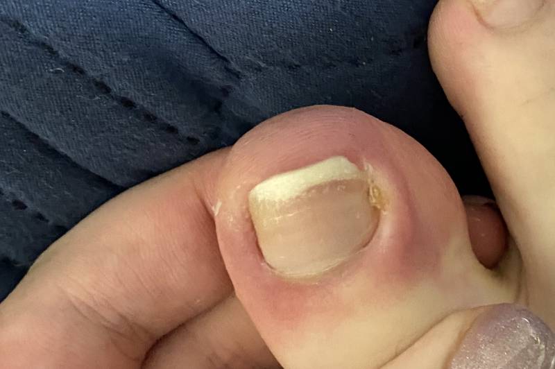 발톱 옆 살이 이렇게 됐는데 이거 병원 가야하지ㅠㅠㅠㅠ (ㅎㅇㅈㅇ) | 인스티즈