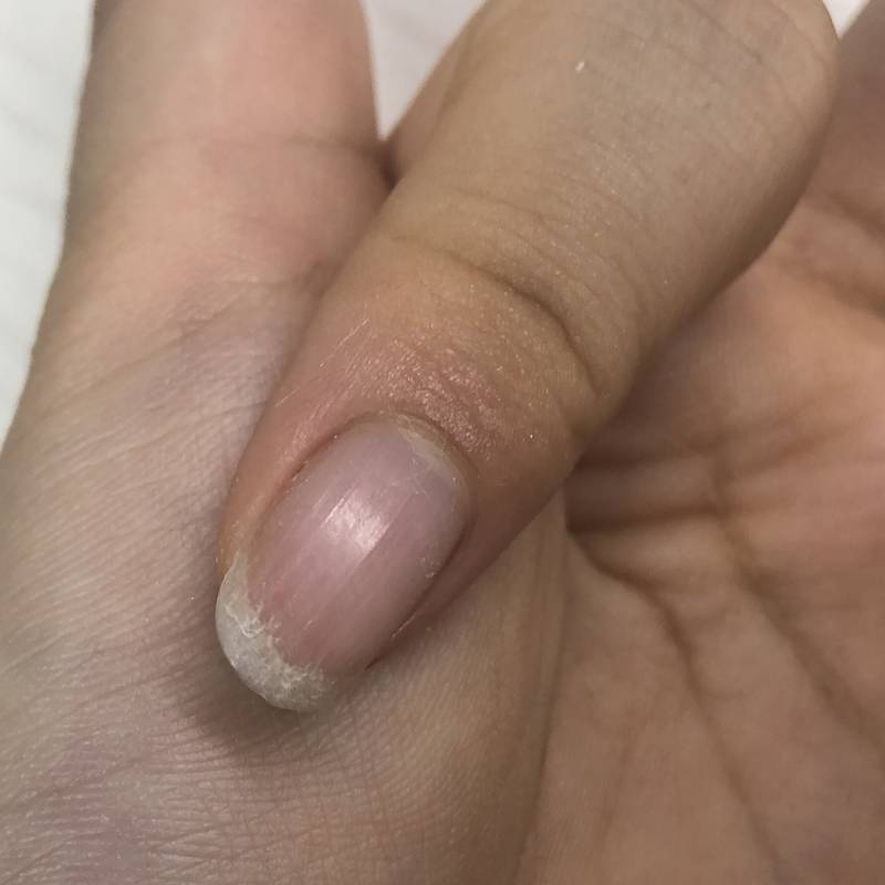 이거 손톱 왜 이러는지 아는 사람... | 인스티즈