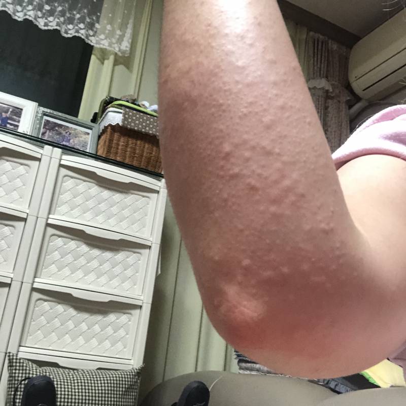 아 피부 왜이러지 (ㅎㅇㅈㅇ) | 인스티즈