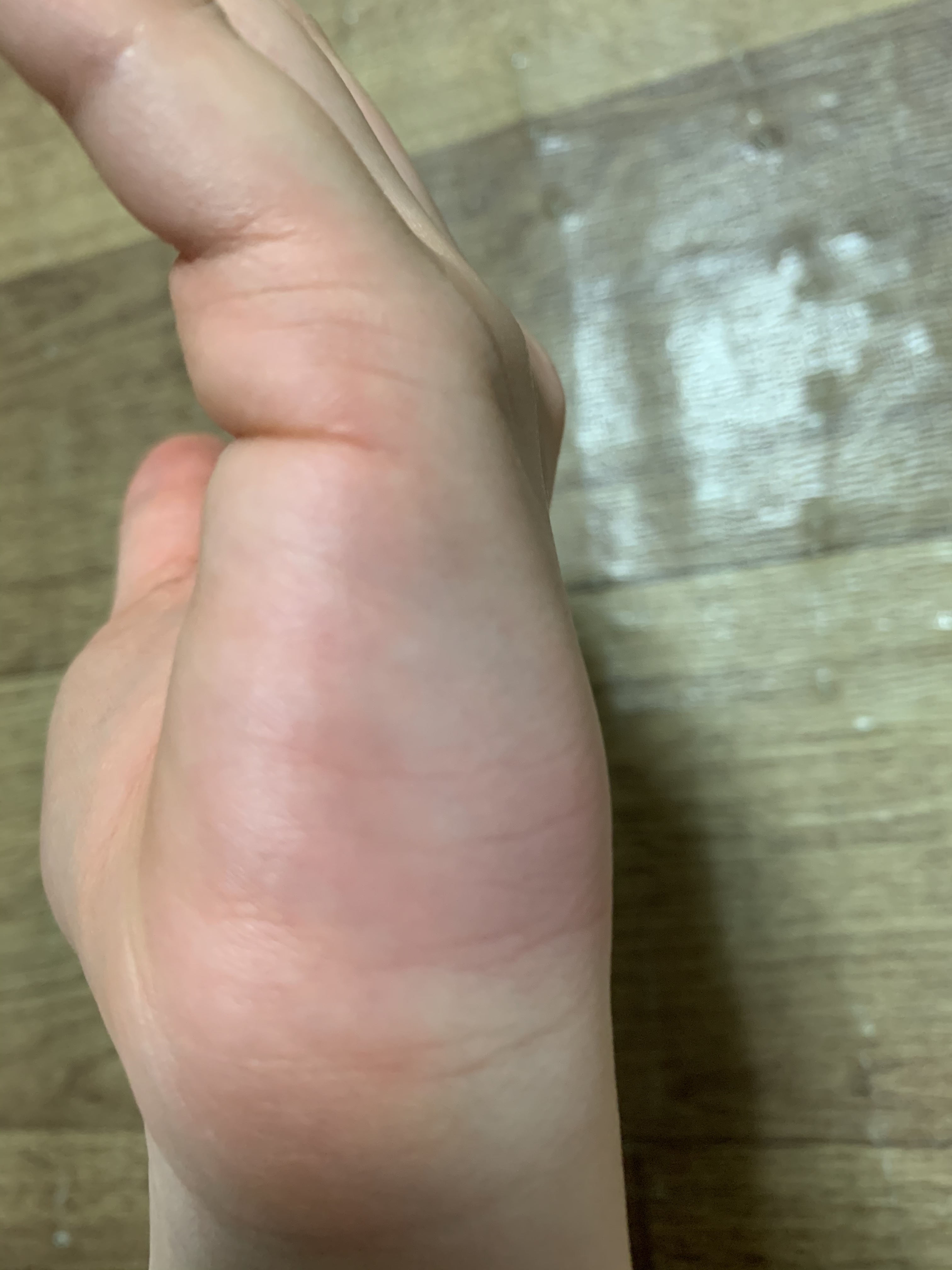 아 모기 물렸어 아악 | 인스티즈