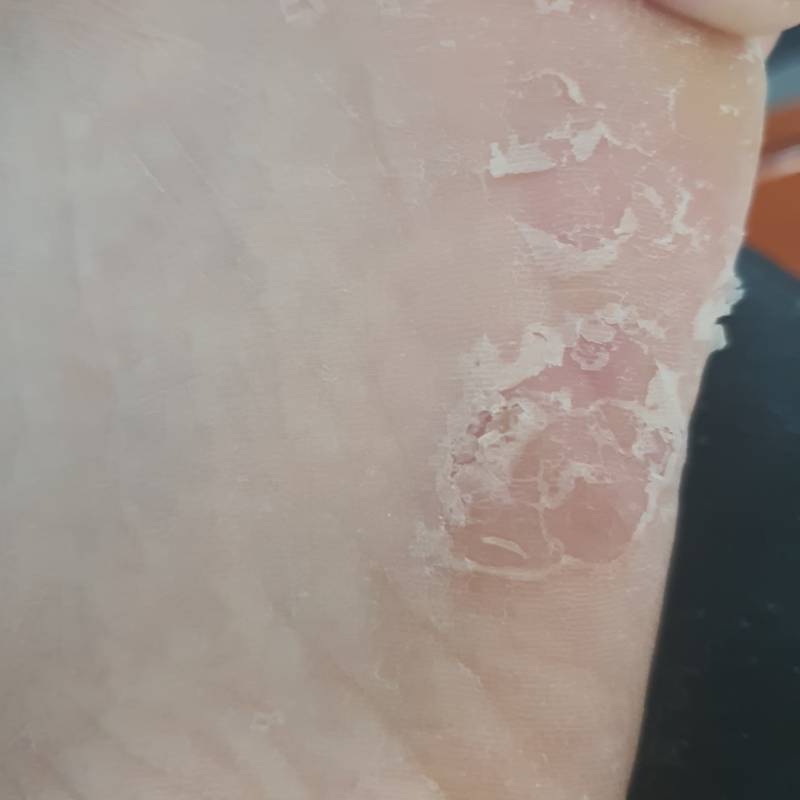 와 나는 발 각질팩 안 믿었거든 대박이야 (혐오주의) | 인스티즈