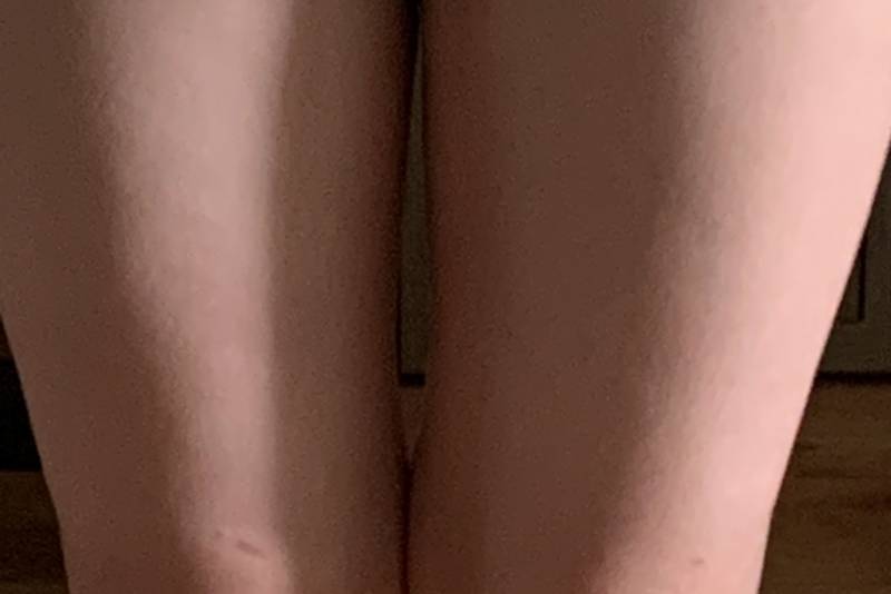 나 허벅지 안쪽 떨어지기 시작함!!!!(사진주의) | 인스티즈