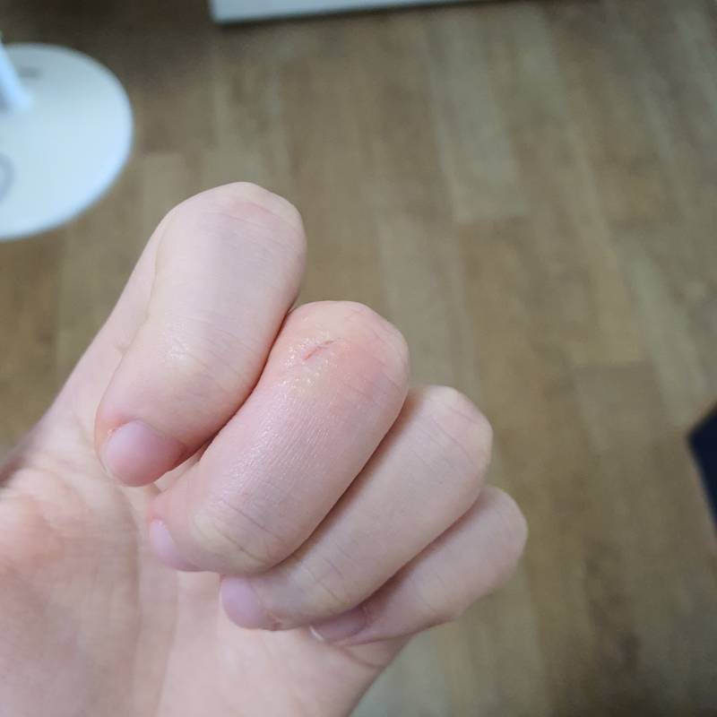 나 상처난거 왜이런지 아는익..? | 인스티즈