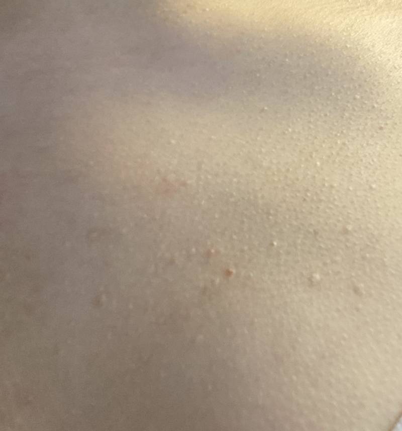 이거 편평 사마귀야?? (ㅎㅇㅈㅇ) | 인스티즈