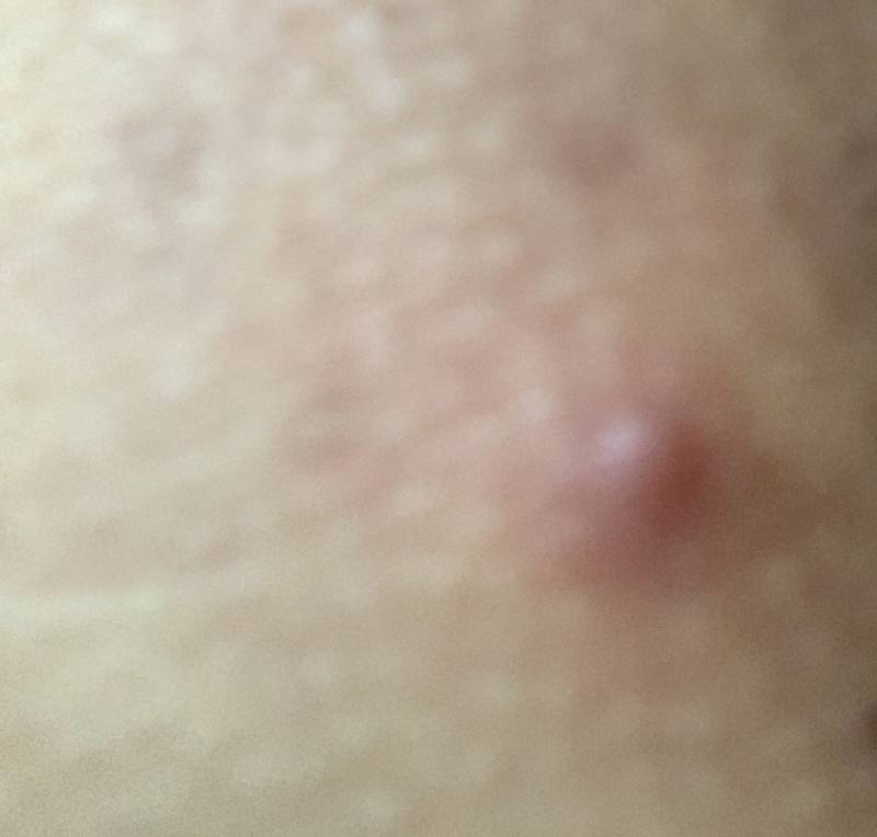 엉덩이에 이런게낫는데 ㅎㅇㅈㅇ | 인스티즈