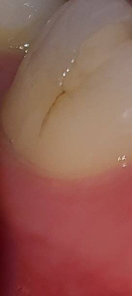 치과 치료 잘 아는 익들아 도와줘..ㅠㅠ | 인스티즈