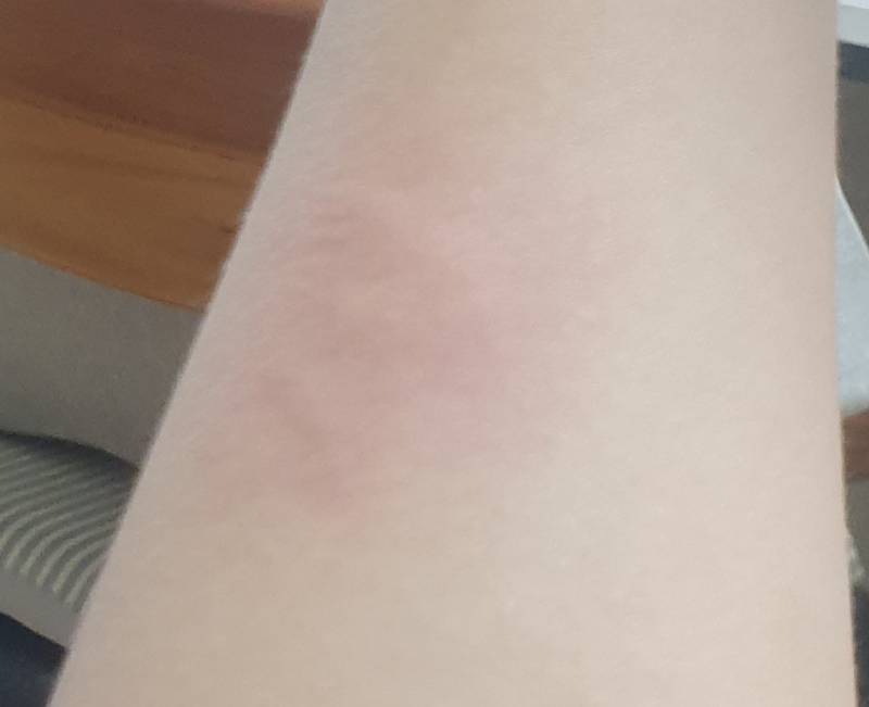 화상이 물집 아니고 선이 올라왔는데 1도야 2도야? | 인스티즈