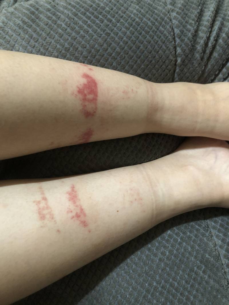 다리에 붉은 반점이 생겼어 ㅜㅜ | 인스티즈