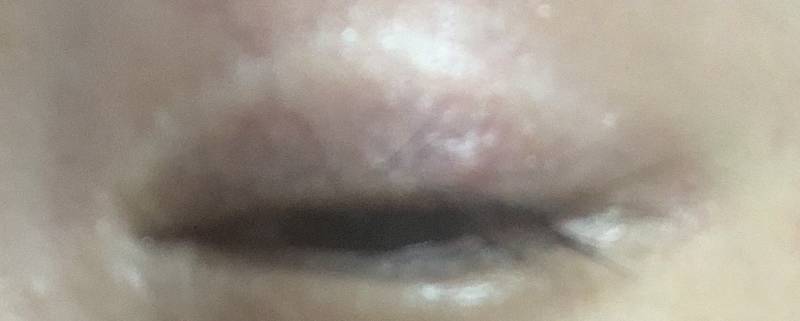 이거 다래끼같아...? | 인스티즈