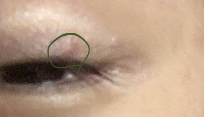 쌍꺼풀에 여드름이나 다래끼? 물집 잡혀본적있는 사람 ㅠㅜ | 인스티즈