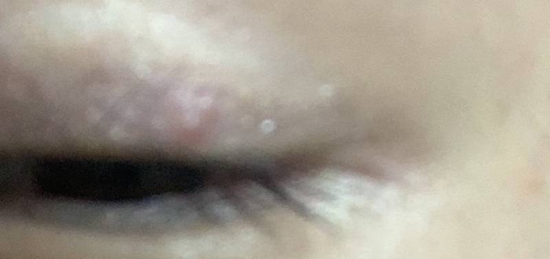 쌍꺼풀에 여드름이나 다래끼? 물집 잡혀본적있는 사람 ㅠㅜ | 인스티즈