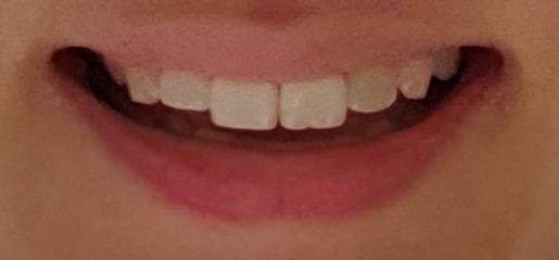 익들 정면보고 웃으면 어디 보여?? | 인스티즈