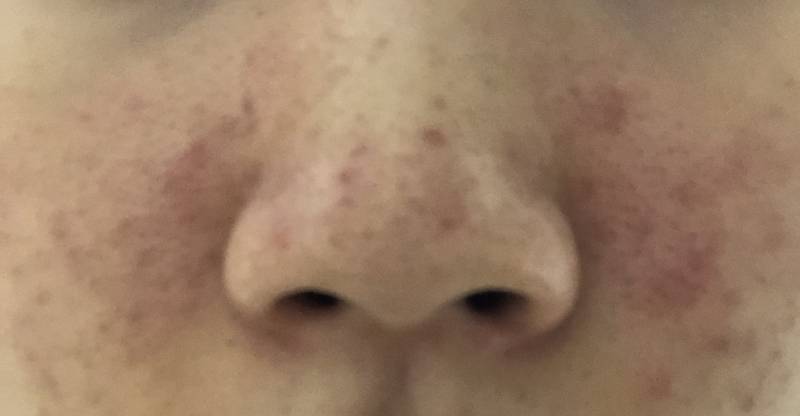 나 피부 뒤집어졌는데 피부과 가보는게 낫겠지?? (혐오주의) | 인스티즈