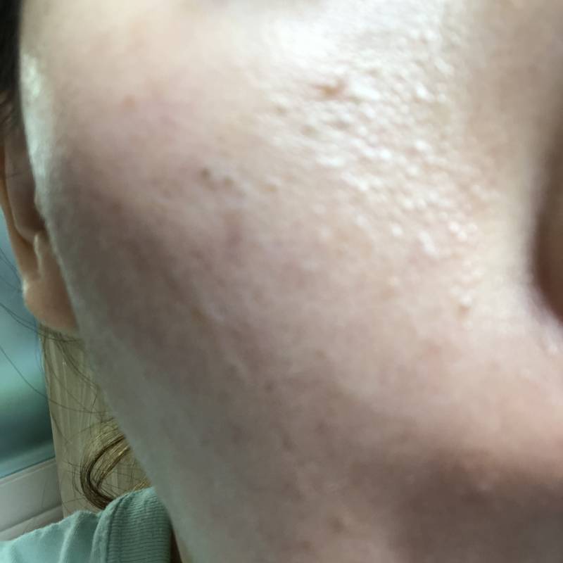 진짜 혐오주의) 있잖어ㅜㅜ 나 피부가 이렇게 안에 피지 엄청 많거든??ㅜㅜ | 인스티즈