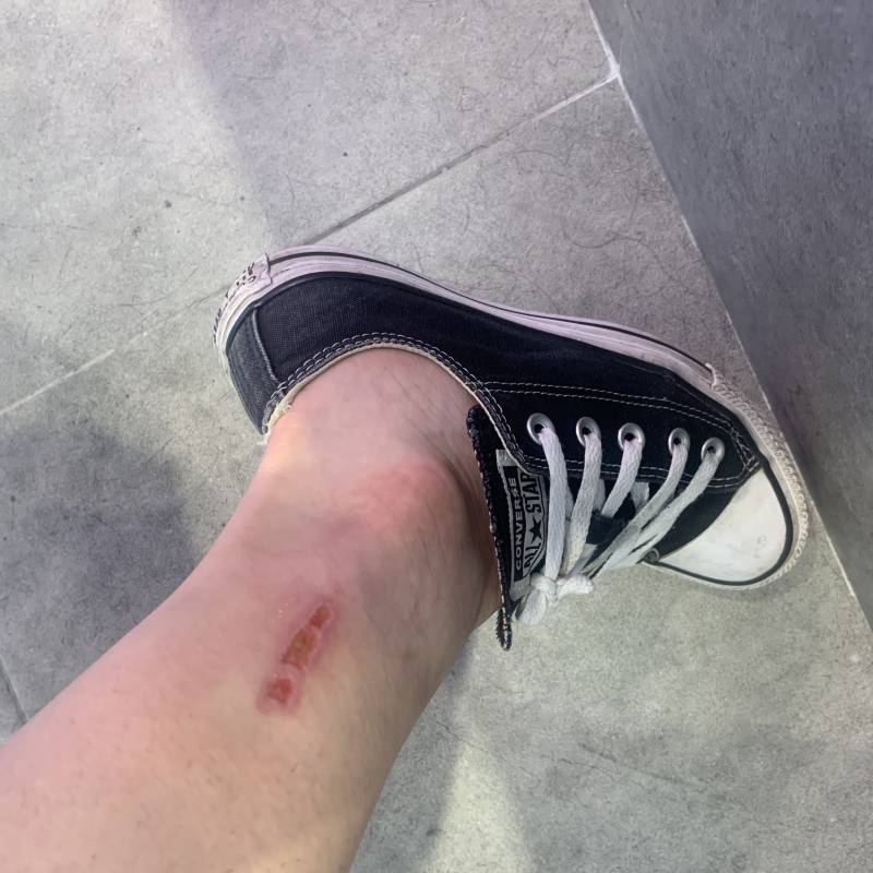 ㅎㅈㅇ) 이정도 다친거 병원가봐야하는거야? | 인스티즈