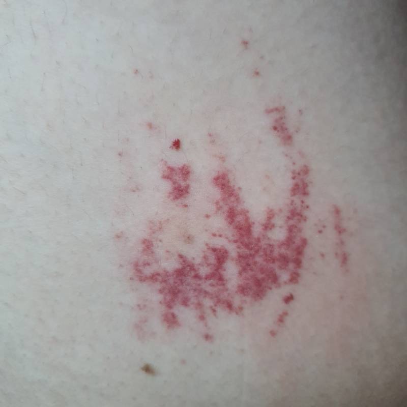 피부 잘아는 익들.. 이거 왜이런건지 아는사람 ㅠㅠ(ㅎㅇㅈㅇ) | 인스티즈