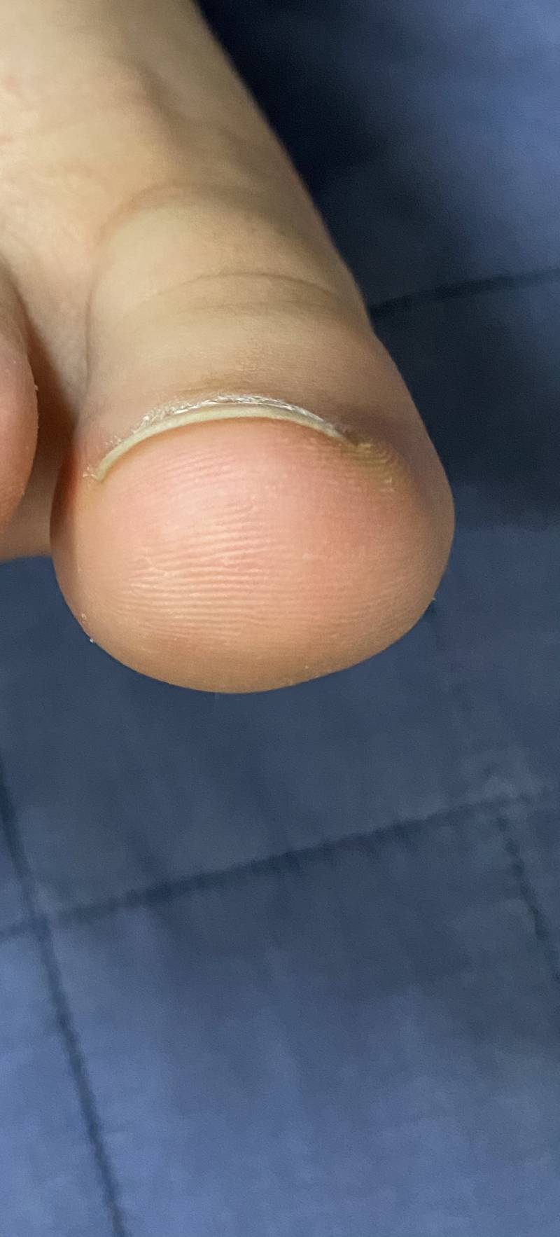 이거도 파고드는 발톱이야??? (더러움 주의) | 인스티즈