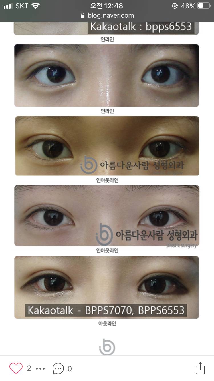 쌍수 인/인아웃/아웃라인 차이가 뭐야...? - 인스티즈(instiz) 뷰티 카테고리