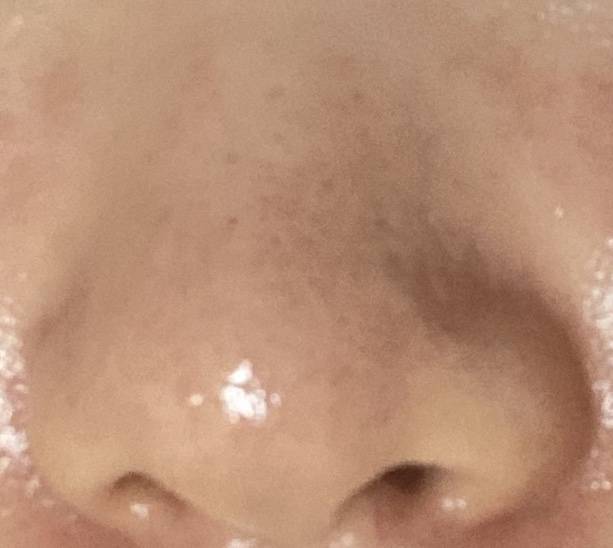 익들아 코에 블랙헤드 어떻게 없애..? ㅠㅠㅠㅠㅠㅠ (사진있음) 스트레스 너무 받아 ㅠㅠㅠ | 인스티즈