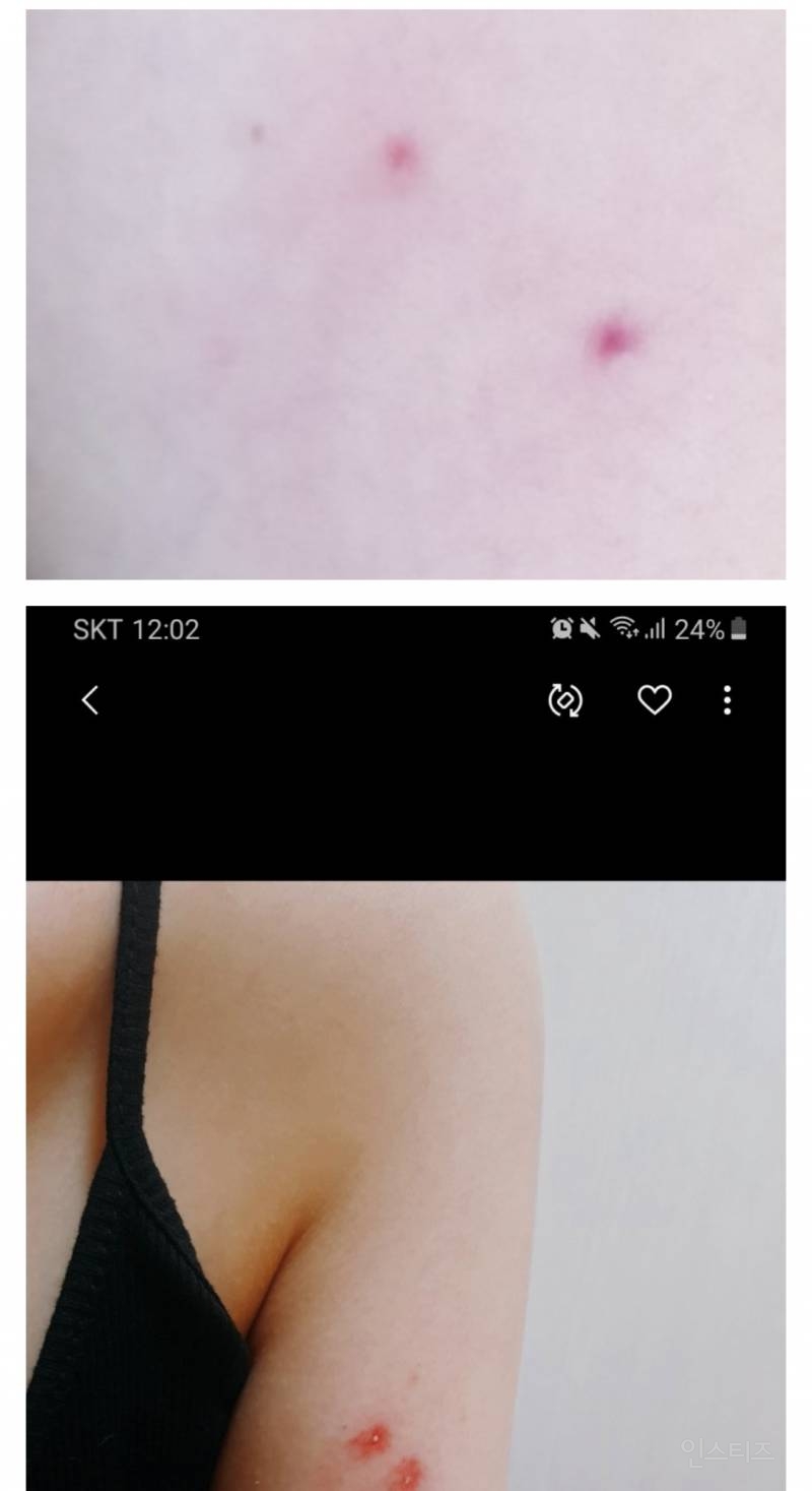 산책하다가 뱀에 물린 디씨인.jpg (혐오주의) | 인스티즈