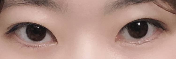 나도 쌍수 할말 봐주라ㅠㅠ | 인스티즈