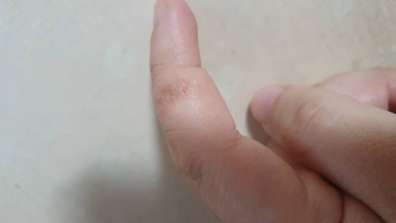 나 손가락 괴사되는거 같아??.... | 인스티즈