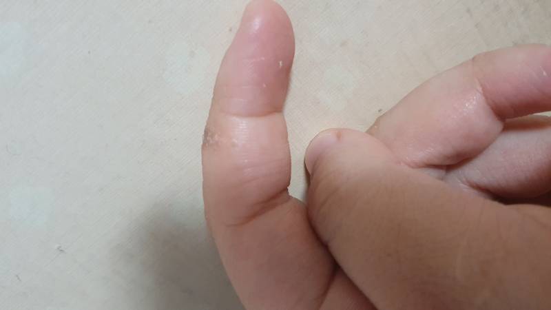 나 손가락 괴사되는거 같아??.... | 인스티즈