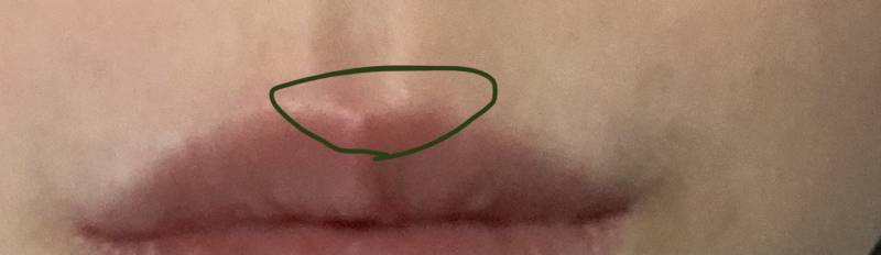 입술산이 빨갛고 아픈데 왜 이러지 ㅜㅜ 뾰루지 난 거 같기도한데 이런적 있는사람 ㅠㅠ | 인스티즈