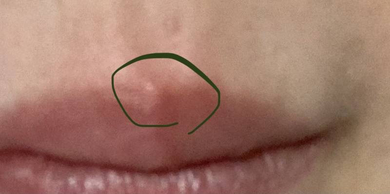 입술산이 빨갛고 아픈데 왜 이러지 ㅜㅜ 뾰루지 난 거 같기도한데 이런적 있는사람 ㅠㅠ | 인스티즈