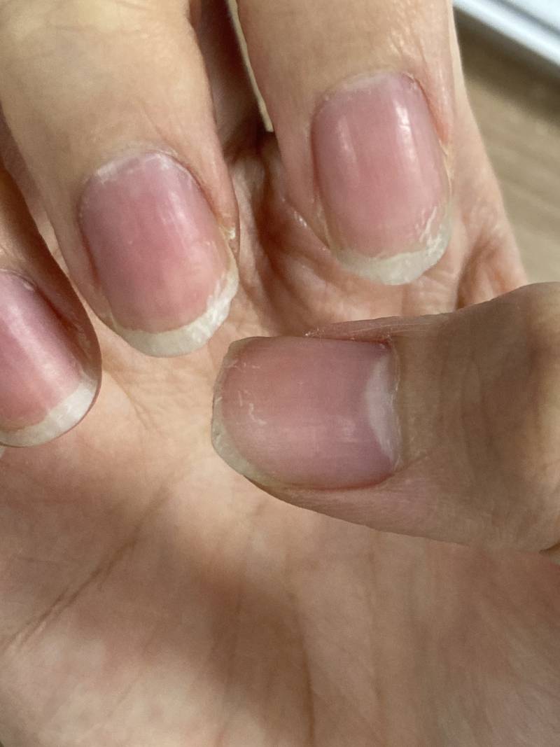 아니 두달 걸쳐서 젤네일 두번하고 제거했는데 원래 이래?? 손톱 다 갈라져😨😨🥶 | 인스티즈