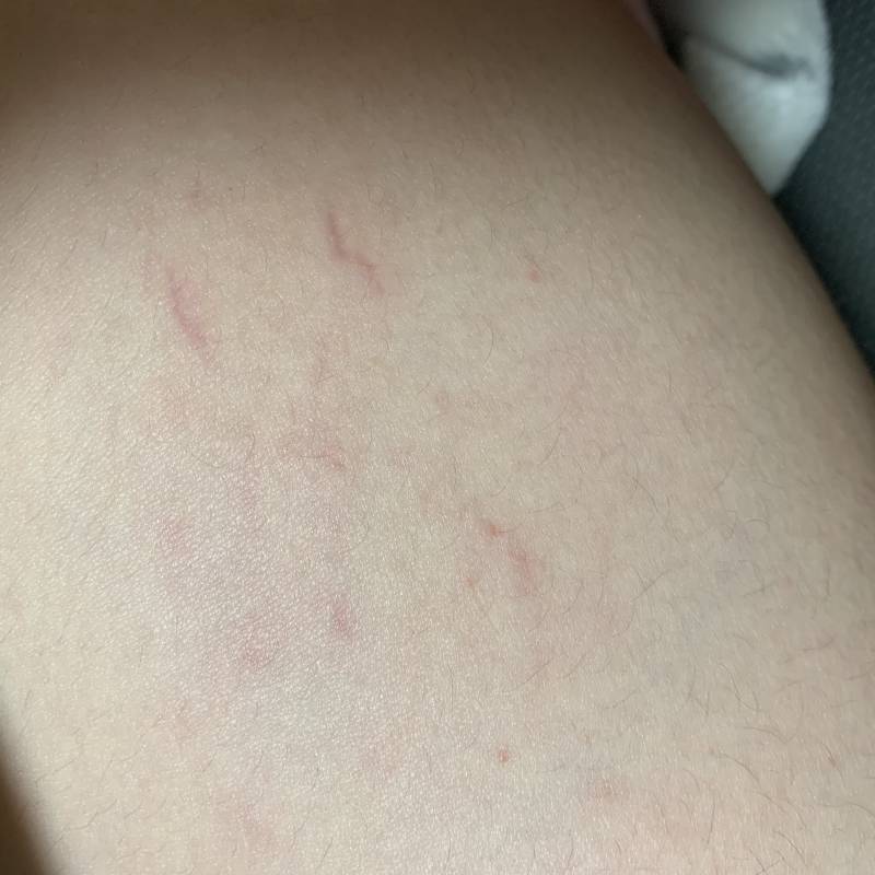 얘들아 이거 튼살이지..........................? | 인스티즈