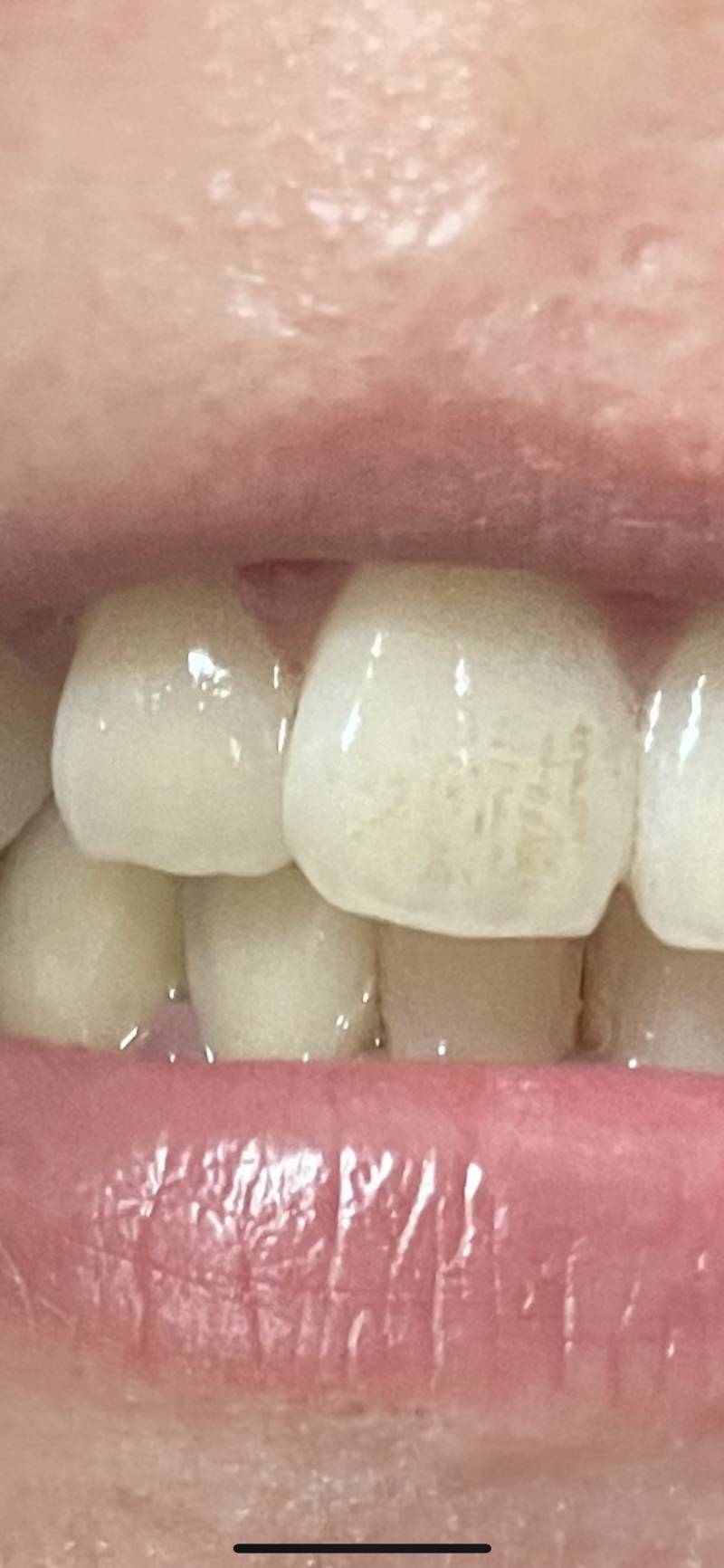 이거 앞니썩은거야????ㅜㅜ 혐오주의 | 인스티즈