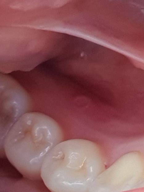 잇몸에 이상한거 생겼는데 이거 뭐지???(ㅇㅎ) | 인스티즈
