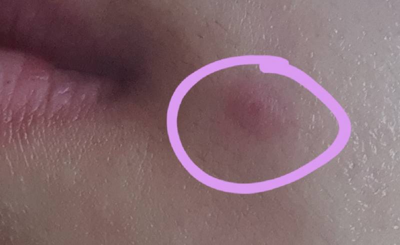 익들아 이거 여드름 흉터 연고 발라야 돼? 아님 마데카솔 발라야 됨? | 인스티즈