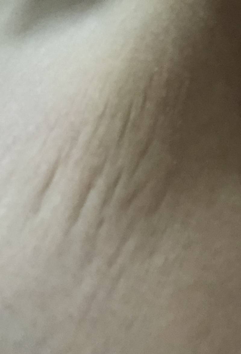 얘들아..내 튼살 어떡해???ㅋㅋ... | 인스티즈